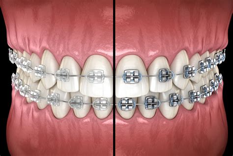 metal or ceramic brackets|traditional metal braces vs ceramic.